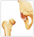 Removing the Damaged Part of Femoral Head